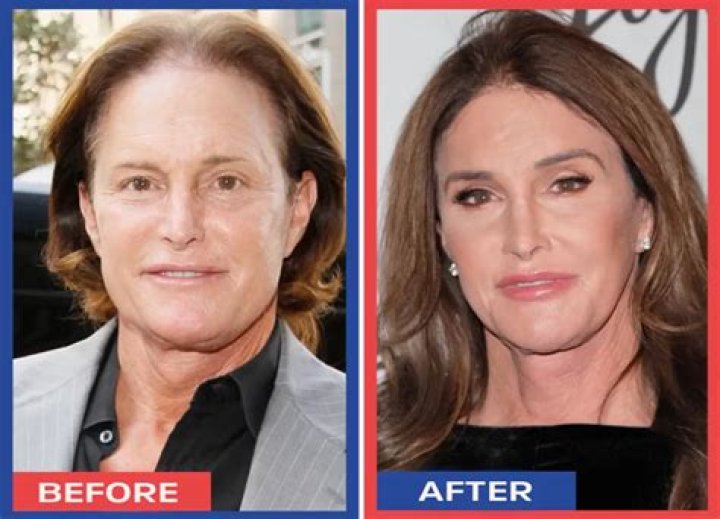 Caitlyn Jenner’s Plastic Surgery Operations Putting 66-Year-Old At Risk - Going To Incredible Lengths To Look Beautiful?