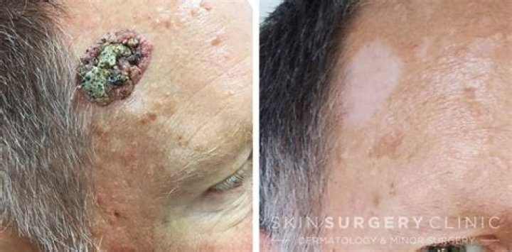 How to remove seborrheic keratosis