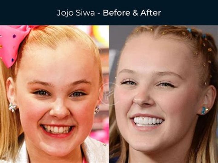 Jon Jones Teeth Before And After What Does He Have On His Teeth?