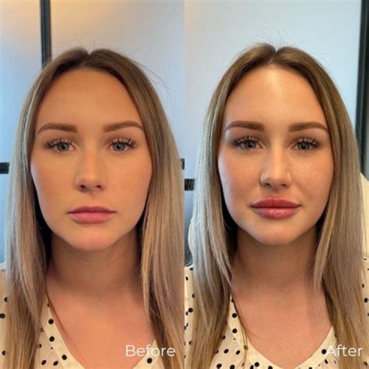 Kristin Davis Lips: Before And After Fillers -Everything On Her Cosmetic Surgery