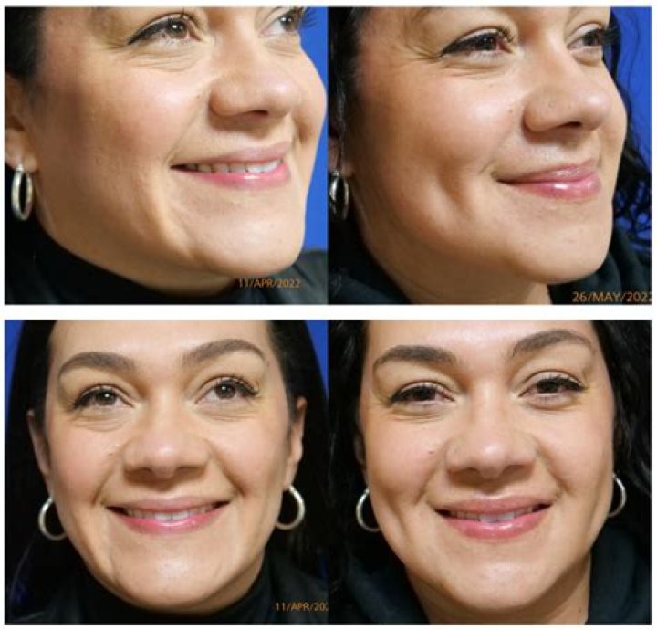 SNL| Did Joe Piscopo Have Plastic Surgery? Before & After Photos On Social Media