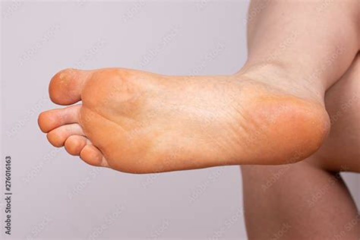 Why are my feet orange